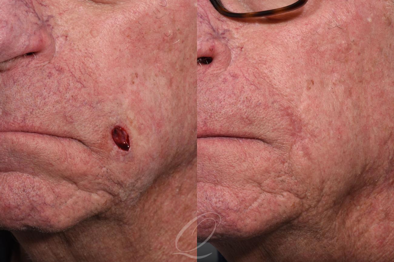 Mohs Reconstruction Case 1439 Before & After Left Oblique | Serving Rochester, Syracuse & Buffalo, NY | Quatela Center for Plastic Surgery