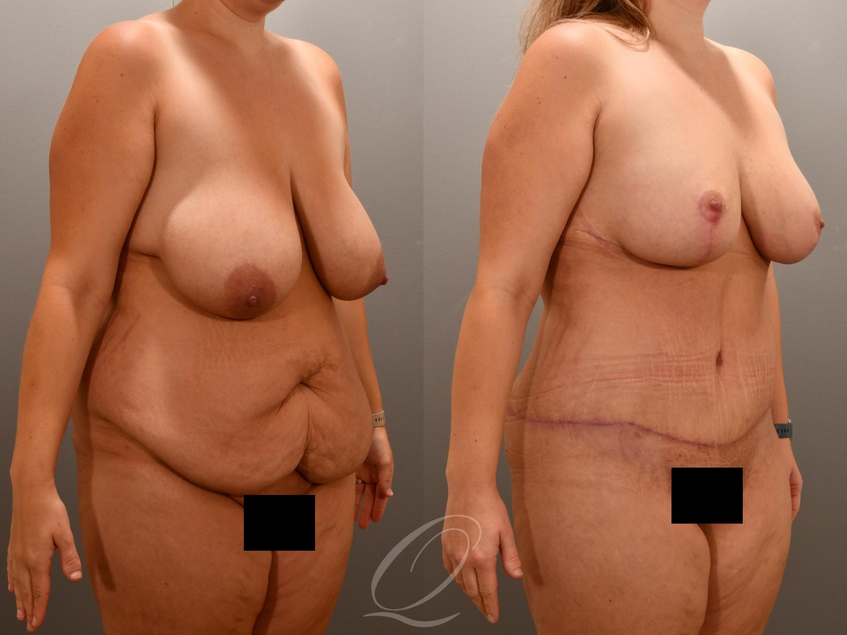 Mommy Makeover Case 1001648 Before & After Right Oblique | Serving Rochester, Syracuse & Buffalo, NY | Quatela Center for Plastic Surgery