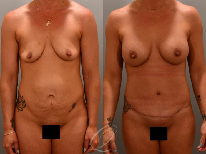 Breast Augmentation Case 1001649 Before & After Front | Serving Rochester, Syracuse & Buffalo, NY | Quatela Center for Plastic Surgery