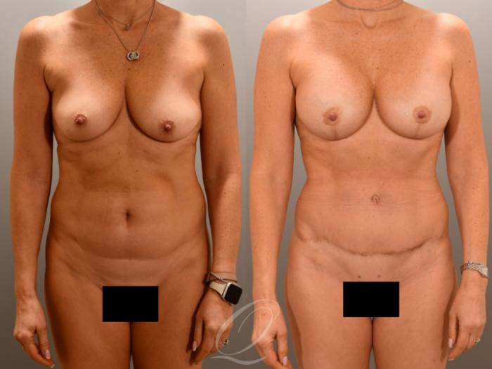 Renuvion Skin Tightening Treatment Case 1001976 Before & After Front | Serving Rochester, Syracuse & Buffalo, NY | Quatela Center for Plastic Surgery