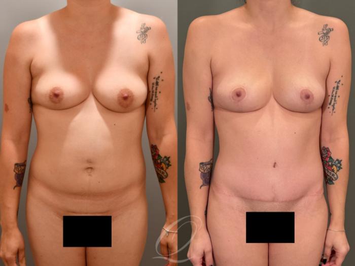 Breast Lift Case 1001977 Before & After Front | Serving Rochester, Syracuse & Buffalo, NY | Quatela Center for Plastic Surgery