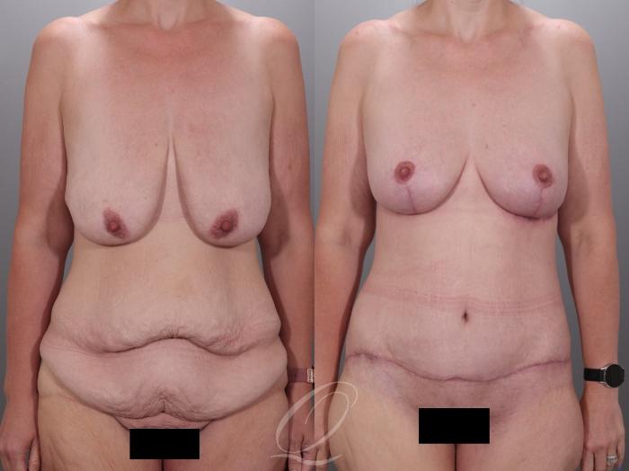 Mommy Makeover Case 1001978 Before & After Front | Serving Rochester, Syracuse & Buffalo, NY | Quatela Center for Plastic Surgery