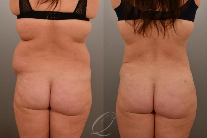 Liposuction Case 1001669 Before & After Back | Serving Rochester, Syracuse & Buffalo, NY | Quatela Center for Plastic Surgery