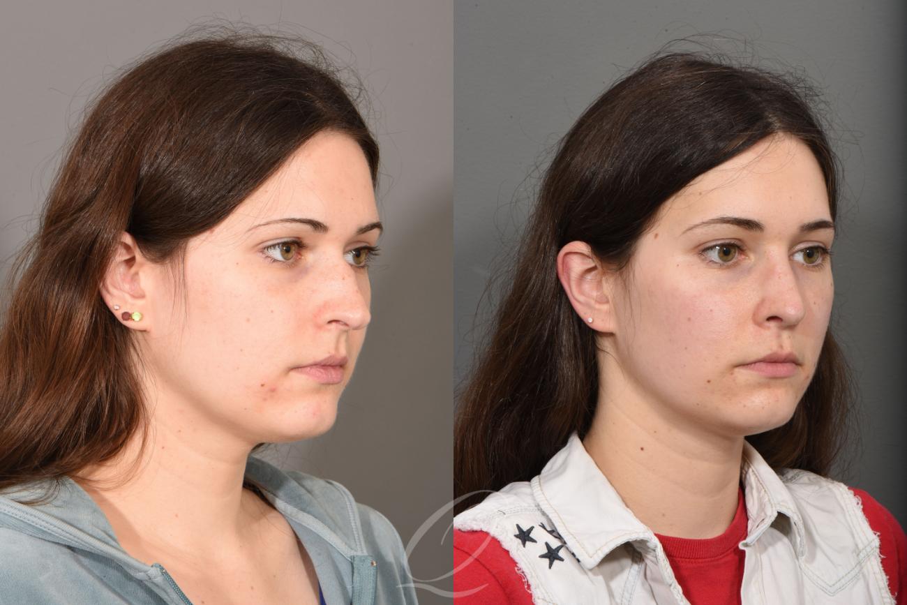 Rhinoplasty Case 1444 Before & After Right Oblique | Serving Rochester, Syracuse & Buffalo, NY | Quatela Center for Plastic Surgery