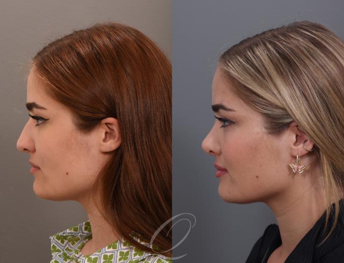 Rhinoplasty Case 1001890 Before & After Right Side | Serving Rochester, Syracuse & Buffalo, NY | Quatela Center for Plastic Surgery