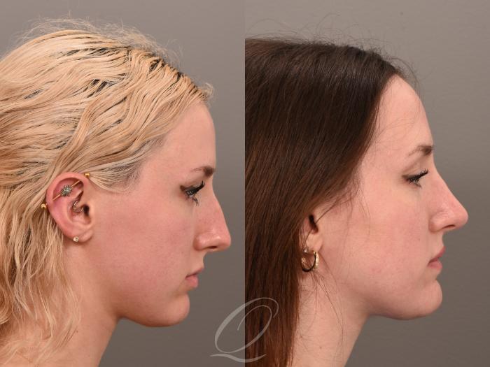 Rhinoplasty Case 1001982 Before & After Right Side | Serving Rochester, Syracuse & Buffalo, NY | Quatela Center for Plastic Surgery