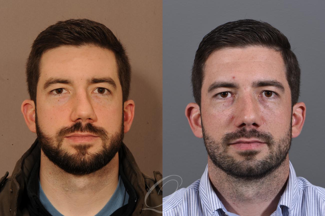 Rhinoplasty Case 1347 Before & After View #1 | Rochester, NY | Quatela Center for Plastic Surgery