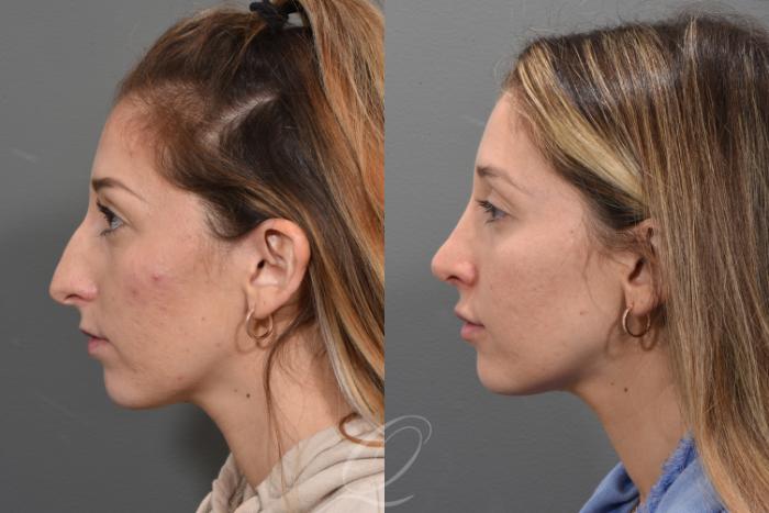 Rhinoplasty Case 1492 Before & After Left Side | Serving Rochester, Syracuse & Buffalo, NY | Quatela Center for Plastic Surgery