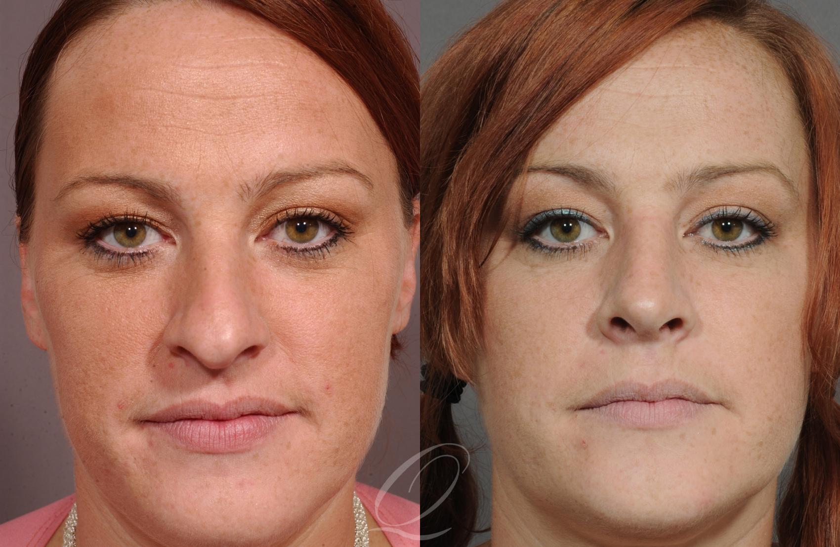 Rhinoplasty Case 49 Before & After View #1 | Rochester, NY | Quatela Center for Plastic Surgery