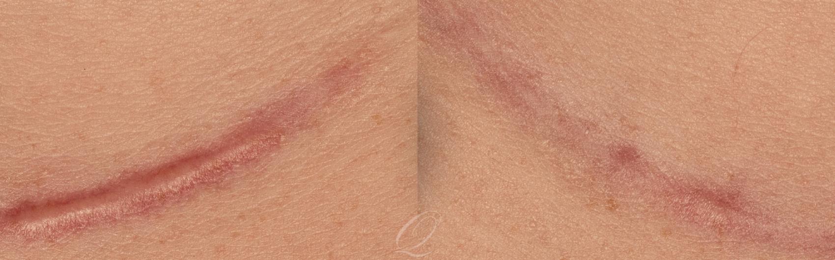 Scar Revision/Therapies Case 245 Before & After View #1 | Serving Rochester, Syracuse & Buffalo, NY | Quatela Center for Plastic Surgery