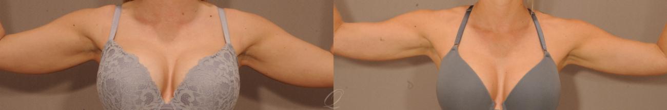 SmartLipo Laser Body Sculpting Case 278 Before & After View #1 | Serving Rochester, Syracuse & Buffalo, NY | Quatela Center for Plastic Surgery