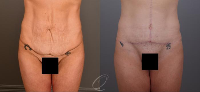 Tummy Tuck Case 1001906 Before & After Front | Serving Rochester, Syracuse & Buffalo, NY | Quatela Center for Plastic Surgery