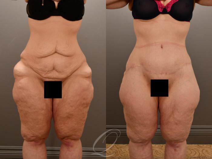 Liposuction Case 1001909 Before & After Front | Serving Rochester, Syracuse & Buffalo, NY | Quatela Center for Plastic Surgery