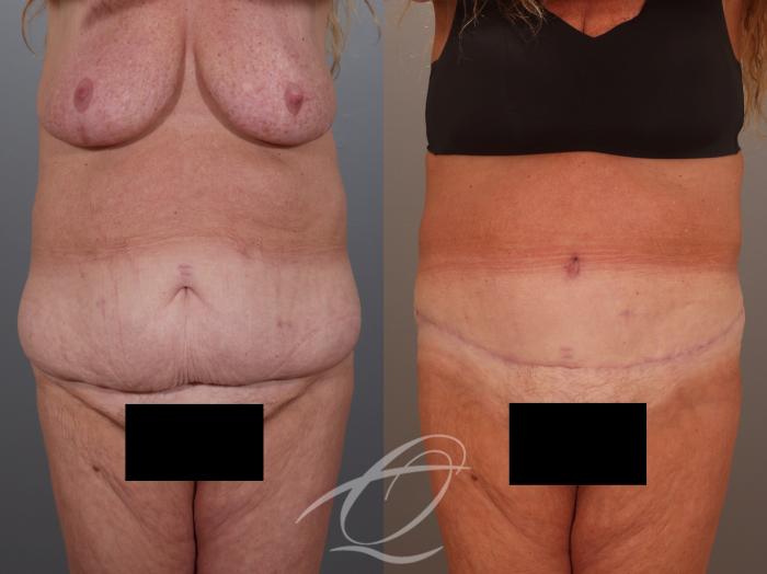 Liposuction Case 1002011 Before & After Front | Serving Rochester, Syracuse & Buffalo, NY | Quatela Center for Plastic Surgery
