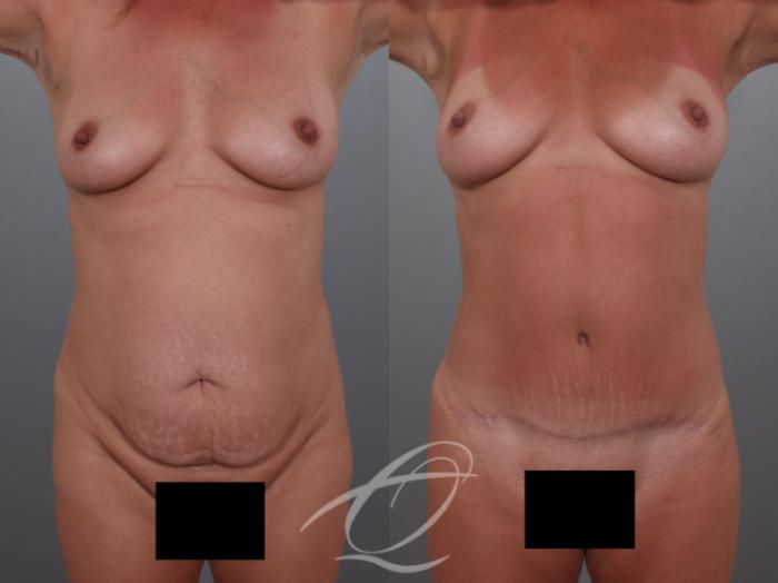 Tummy Tuck Case 1002029 Before & After Front | Serving Rochester, Syracuse & Buffalo, NY | Quatela Center for Plastic Surgery