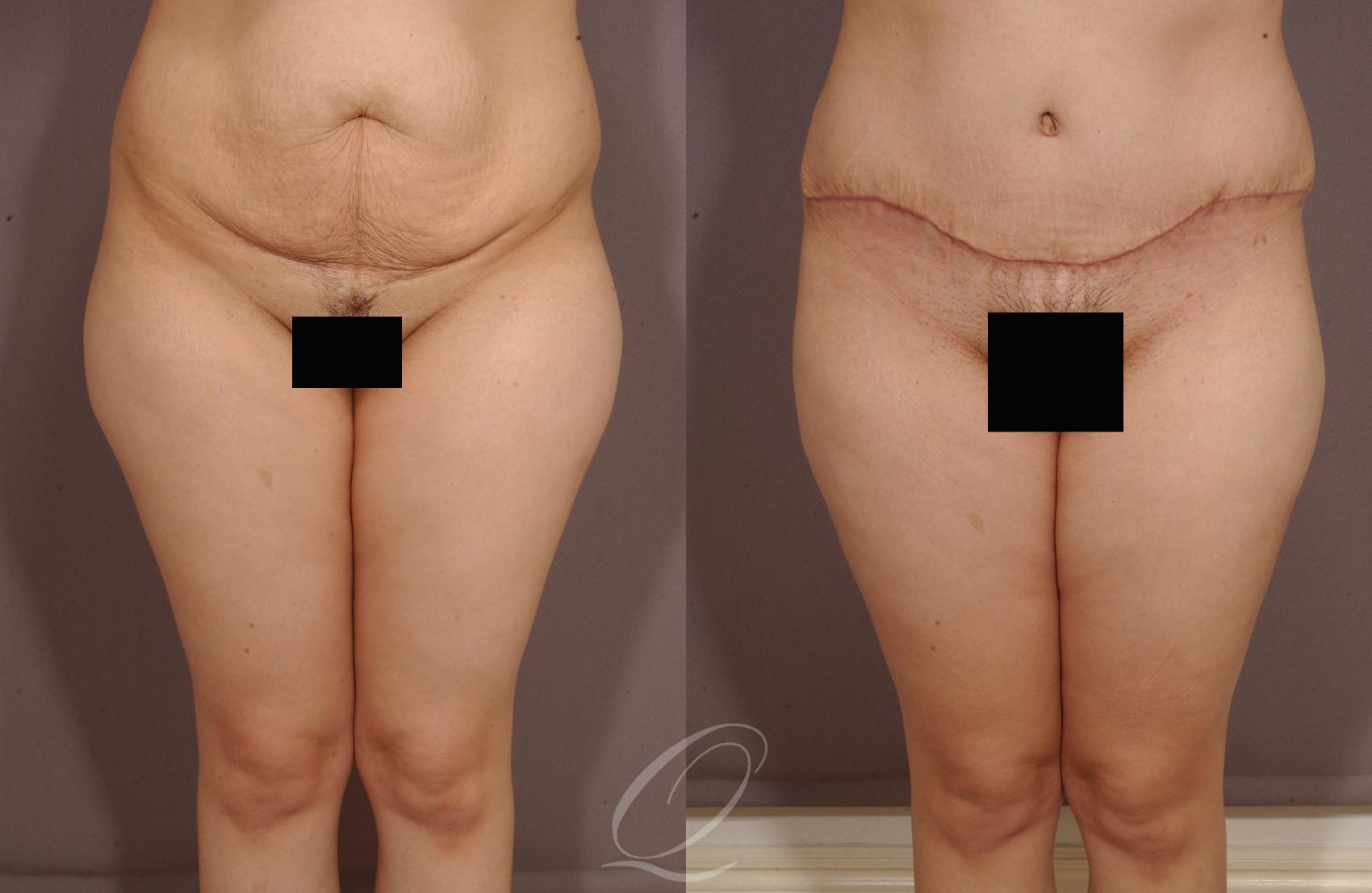 Tummy Tuck Case 149 Before & After View #1 | Rochester, NY | Quatela Center for Plastic Surgery