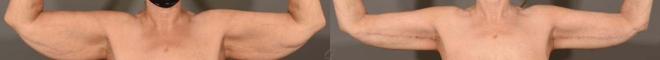 Arm Lift Case 390 Before & After Front | Serving Rochester, Syracuse & Buffalo, NY | Quatela Center for Plastic Surgery