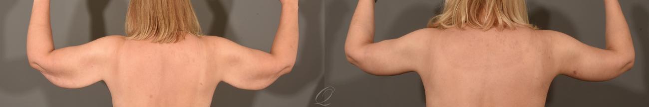 Arm Lift Case 1365 Before & After Back | Serving Rochester, Syracuse & Buffalo, NY | Quatela Center for Plastic Surgery