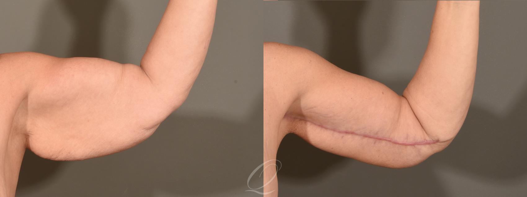 Arm Lift Case 1001568 Before & After Left Side | Serving Rochester, Syracuse & Buffalo, NY | Quatela Center for Plastic Surgery