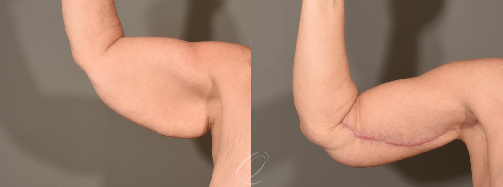 Arm Lift Case 1001568 Before & After Right Side | Serving Rochester, Syracuse & Buffalo, NY | Quatela Center for Plastic Surgery