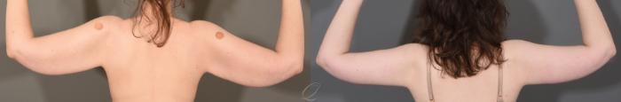 Arm Lift Case 1001612 Before & After Back | Serving Rochester, Syracuse & Buffalo, NY | Quatela Center for Plastic Surgery