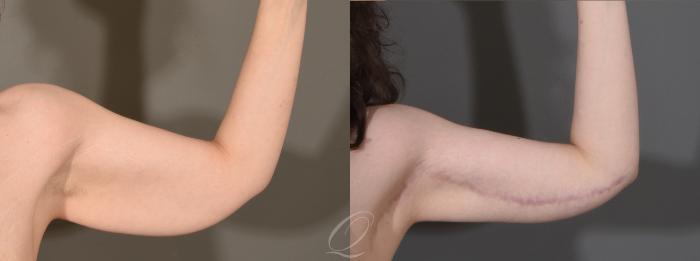 Arm Lift Case 1001612 Before & After Left Side Front | Serving Rochester, Syracuse & Buffalo, NY | Quatela Center for Plastic Surgery