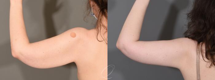 Arm Lift Case 1001612 Before & After Left Side | Serving Rochester, Syracuse & Buffalo, NY | Quatela Center for Plastic Surgery