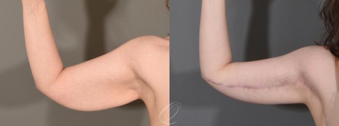 Arm Lift Case 1001612 Before & After Right Side Front | Serving Rochester, Syracuse & Buffalo, NY | Quatela Center for Plastic Surgery