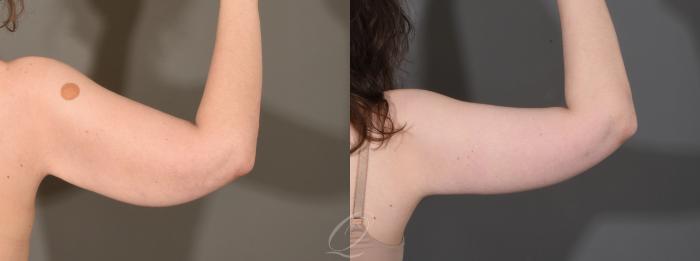 Arm Lift Case 1001612 Before & After Right Side | Serving Rochester, Syracuse & Buffalo, NY | Quatela Center for Plastic Surgery