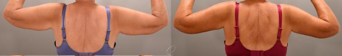 Arm Lift Case 1001626 Before & After Back | Serving Rochester, Syracuse & Buffalo, NY | Quatela Center for Plastic Surgery