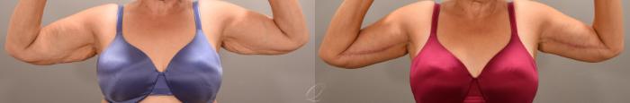 Arm Lift Case 1001626 Before & After Front | Serving Rochester, Syracuse & Buffalo, NY | Quatela Center for Plastic Surgery