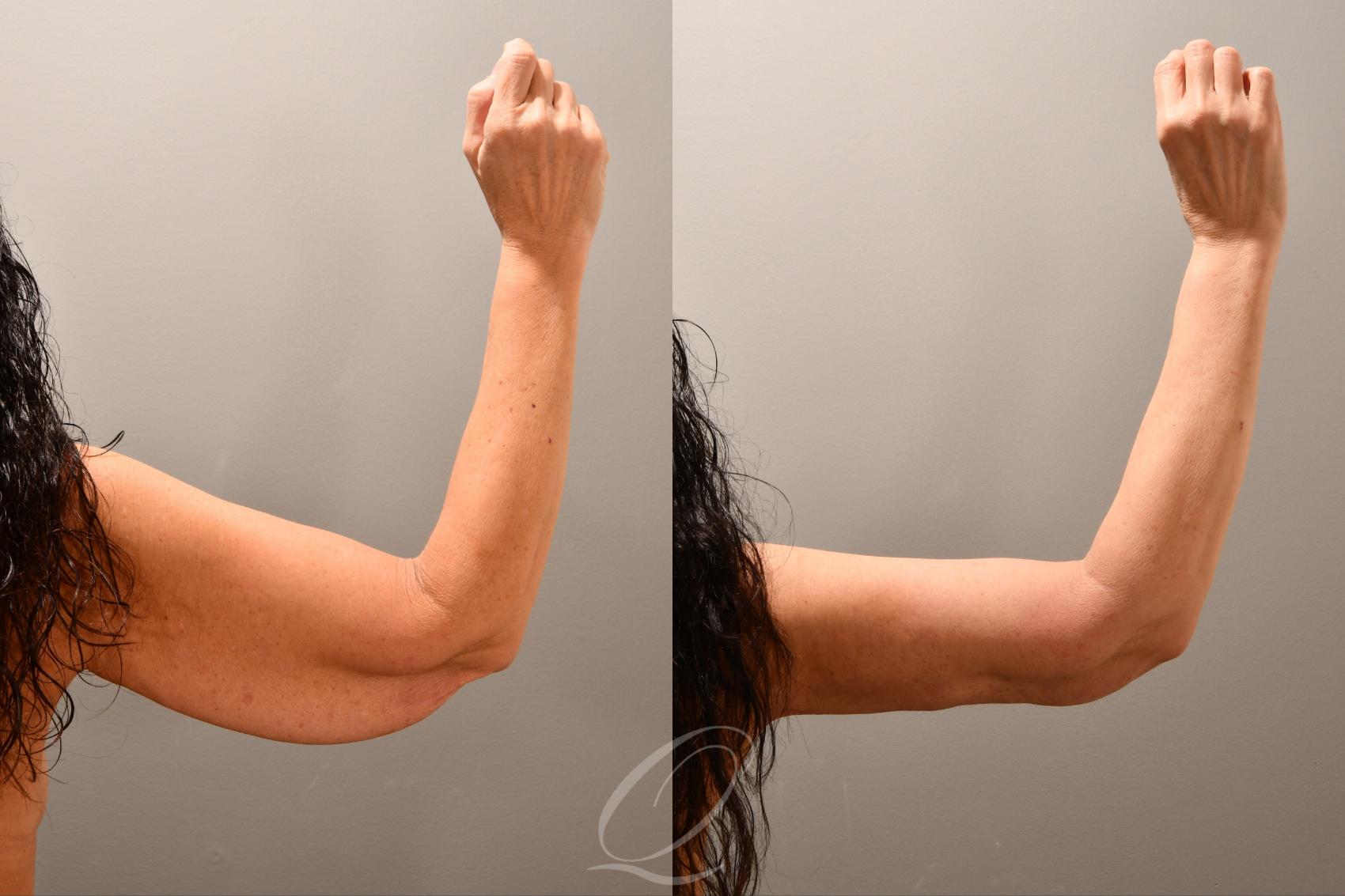 Arm Lift Case 1001761 Before & After Right Side | Serving Rochester, Syracuse & Buffalo, NY | Quatela Center for Plastic Surgery