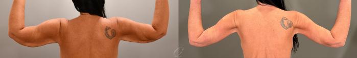 Arm Lift Case 1001855 Before & After Back | Serving Rochester, Syracuse & Buffalo, NY | Quatela Center for Plastic Surgery