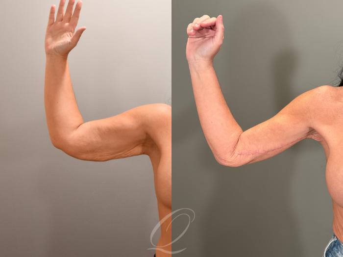 Arm Lift Case 1001855 Before & After Left Front | Serving Rochester, Syracuse & Buffalo, NY | Quatela Center for Plastic Surgery