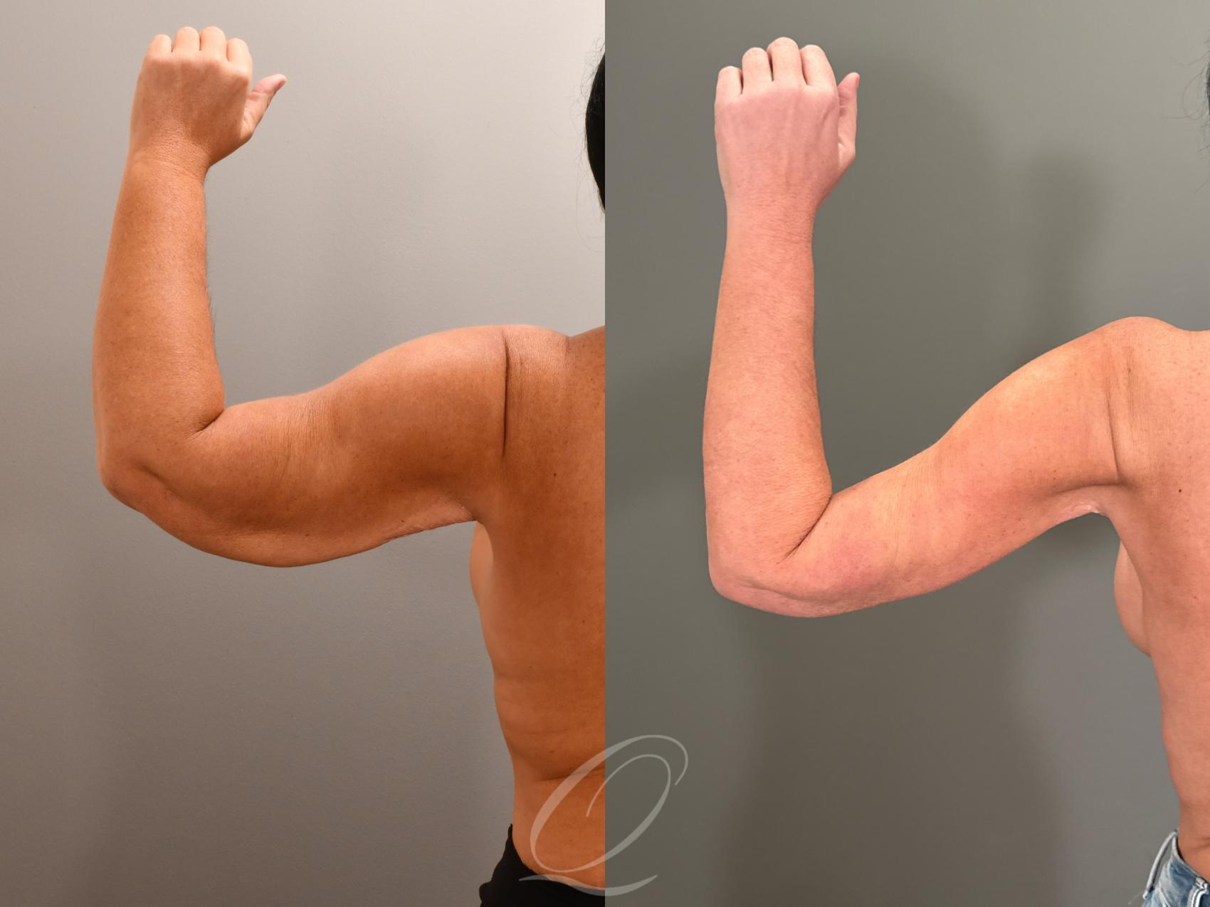 Arm Lift Case 1001855 Before & After Left Side | Serving Rochester, Syracuse & Buffalo, NY | Quatela Center for Plastic Surgery