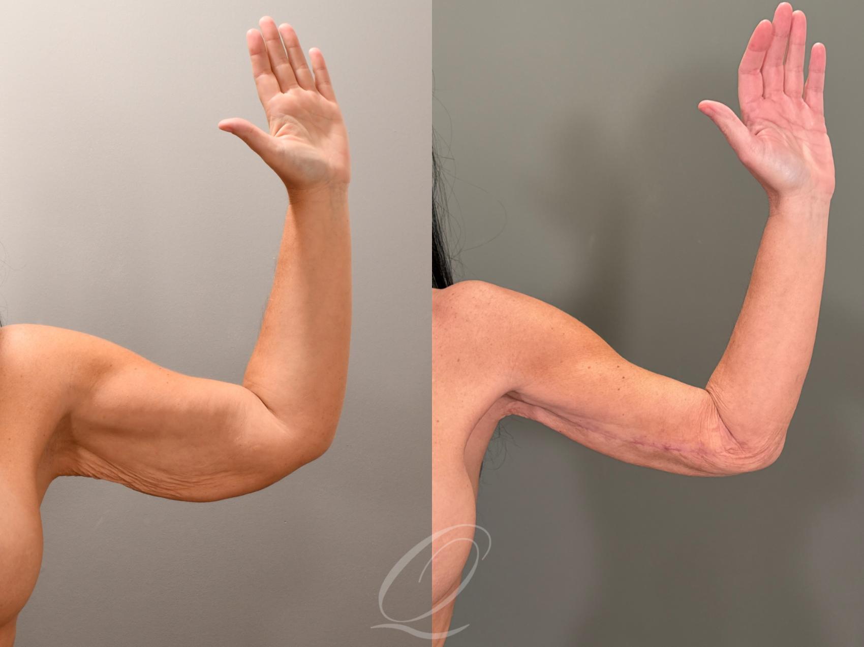 Arm Lift Case 1001855 Before & After Right Front | Serving Rochester, Syracuse & Buffalo, NY | Quatela Center for Plastic Surgery
