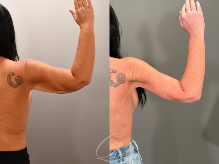 Arm Lift Case 1001855 Before & After Right Side | Serving Rochester, Syracuse & Buffalo, NY | Quatela Center for Plastic Surgery