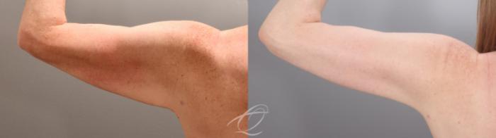 Arm Lift Case 1002016 Before & After Left Oblique | Serving Rochester, Syracuse & Buffalo, NY | Quatela Center for Plastic Surgery