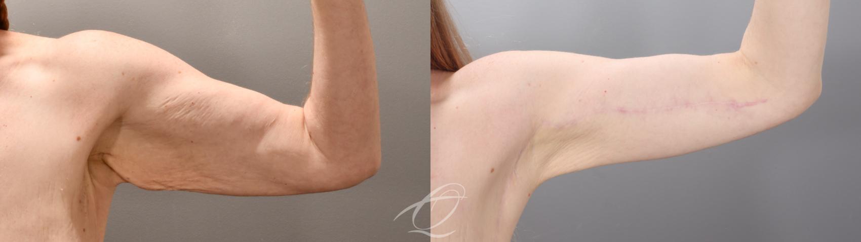 Arm Lift Case 1002016 Before & After Left Side | Serving Rochester, Syracuse & Buffalo, NY | Quatela Center for Plastic Surgery
