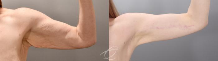 Arm Lift Case 1002016 Before & After Left Side | Serving Rochester, Syracuse & Buffalo, NY | Quatela Center for Plastic Surgery