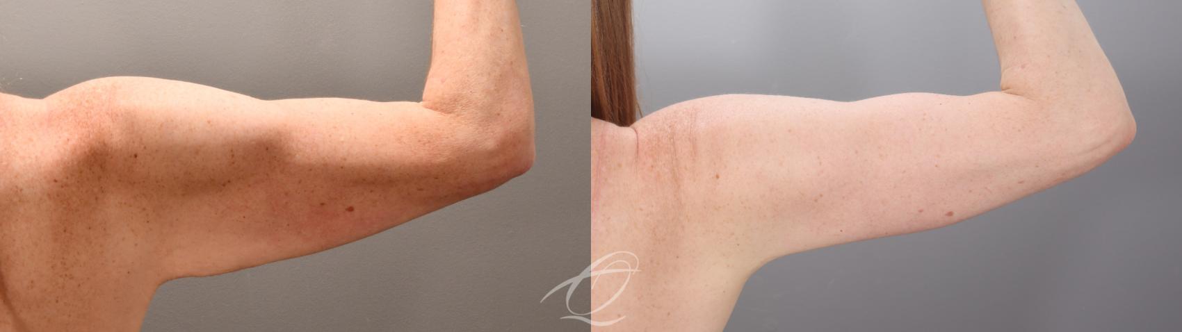 Arm Lift Case 1002016 Before & After Right Oblique | Serving Rochester, Syracuse & Buffalo, NY | Quatela Center for Plastic Surgery