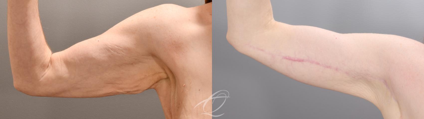 Arm Lift Case 1002016 Before & After Right Side | Serving Rochester, Syracuse & Buffalo, NY | Quatela Center for Plastic Surgery