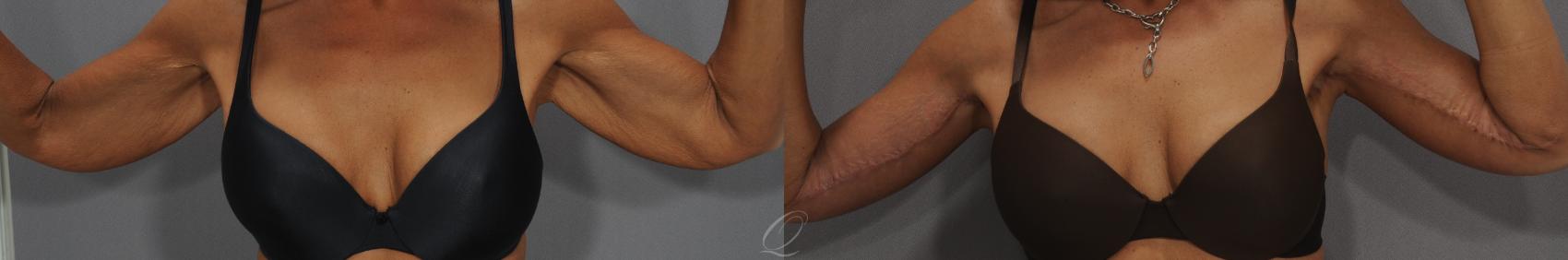 Arm Lift Case 110 Before & After View #1 | Serving Rochester, Syracuse & Buffalo, NY | Quatela Center for Plastic Surgery