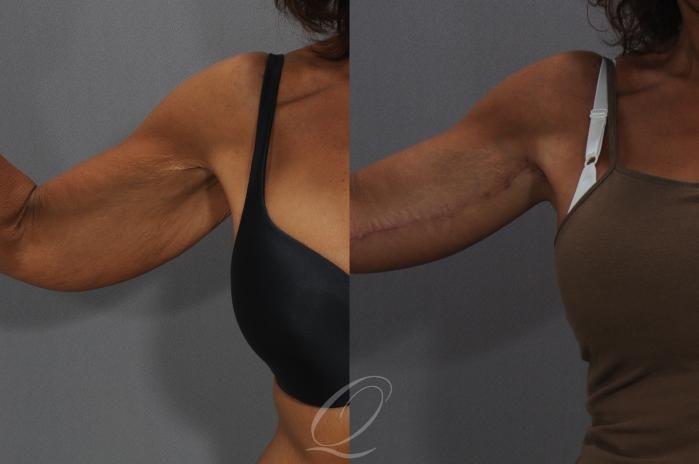 Arm Lift Case 110 Before & After View #2 | Serving Rochester, Syracuse & Buffalo, NY | Quatela Center for Plastic Surgery