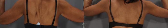 Arm Lift Case 110 Before & After View #3 | Serving Rochester, Syracuse & Buffalo, NY | Quatela Center for Plastic Surgery