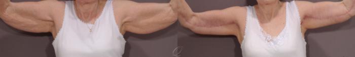 Arm Lift Case 111 Before & After View #1 | Serving Rochester, Syracuse & Buffalo, NY | Quatela Center for Plastic Surgery