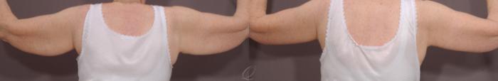 Arm Lift Case 111 Before & After View #2 | Serving Rochester, Syracuse & Buffalo, NY | Quatela Center for Plastic Surgery