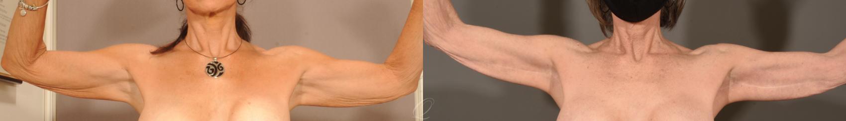 Arm Lift Case 1142 Before & After View #1 | Serving Rochester, Syracuse & Buffalo, NY | Quatela Center for Plastic Surgery