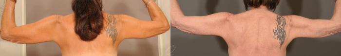 Arm Lift Case 1142 Before & After View #2 | Serving Rochester, Syracuse & Buffalo, NY | Quatela Center for Plastic Surgery