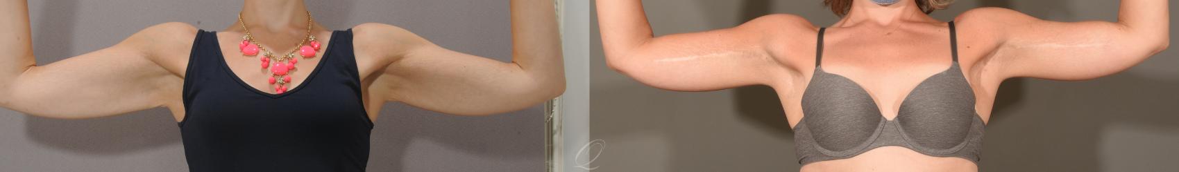 Arm Lift Case 1157 Before & After View #1 | Serving Rochester, Syracuse & Buffalo, NY | Quatela Center for Plastic Surgery